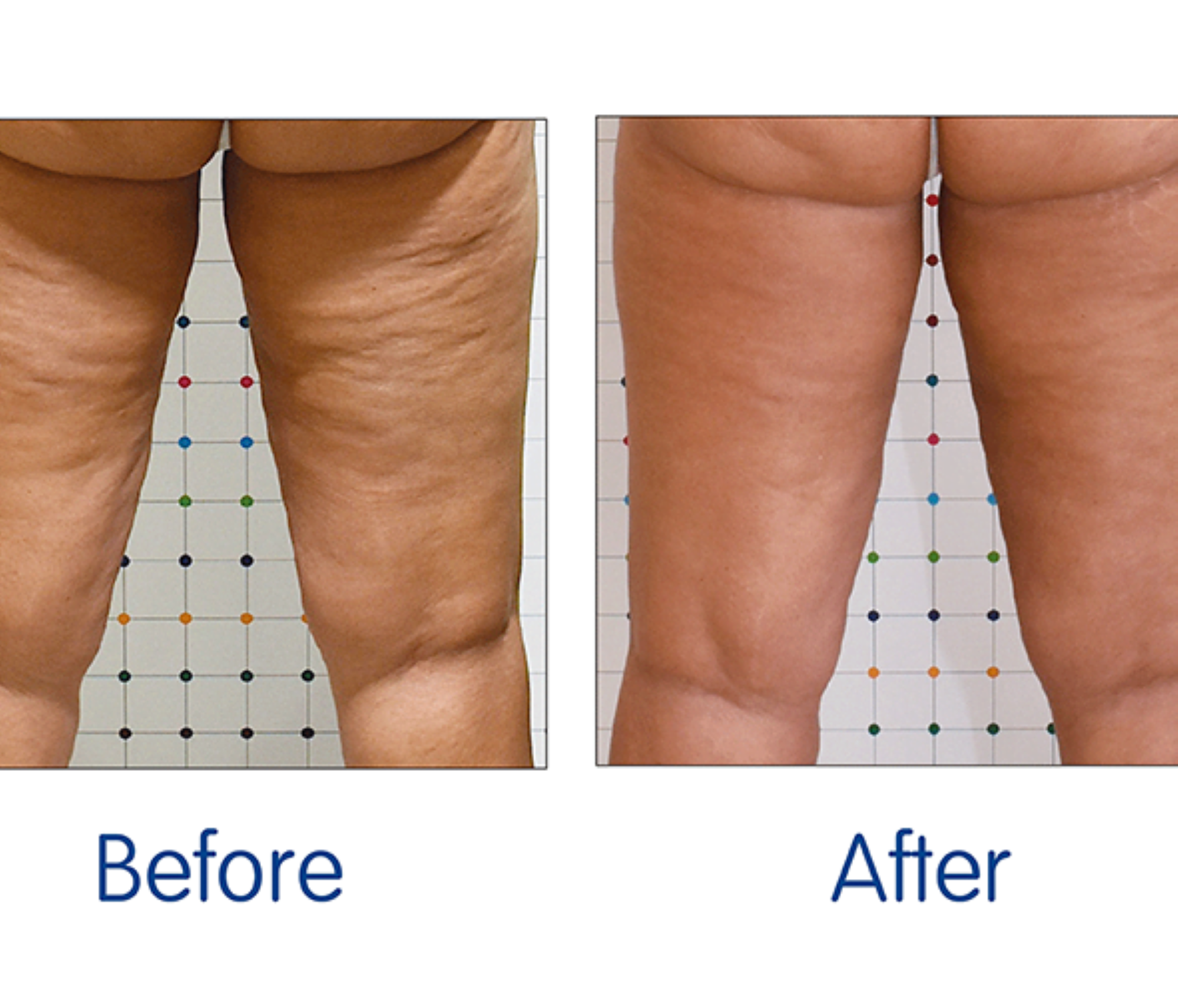 CELLULITE & Stretch Marks ointment with Shea butter,  Tea tree, neem, aloe vera, Gotu kola,