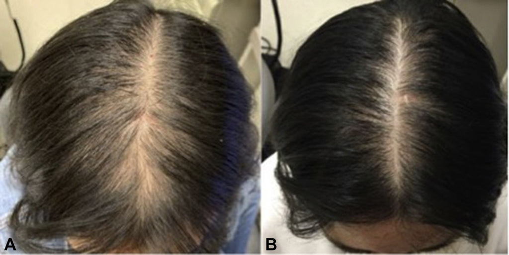 HAIR GROWTH TREATMENT OIL with Peppermint Oil, Tea Tree Oil, Argan oil, Jojoba seed, Avocado oil, Castor oil, Sweet Almond, Vitamin E Oil for Scalp and Hair