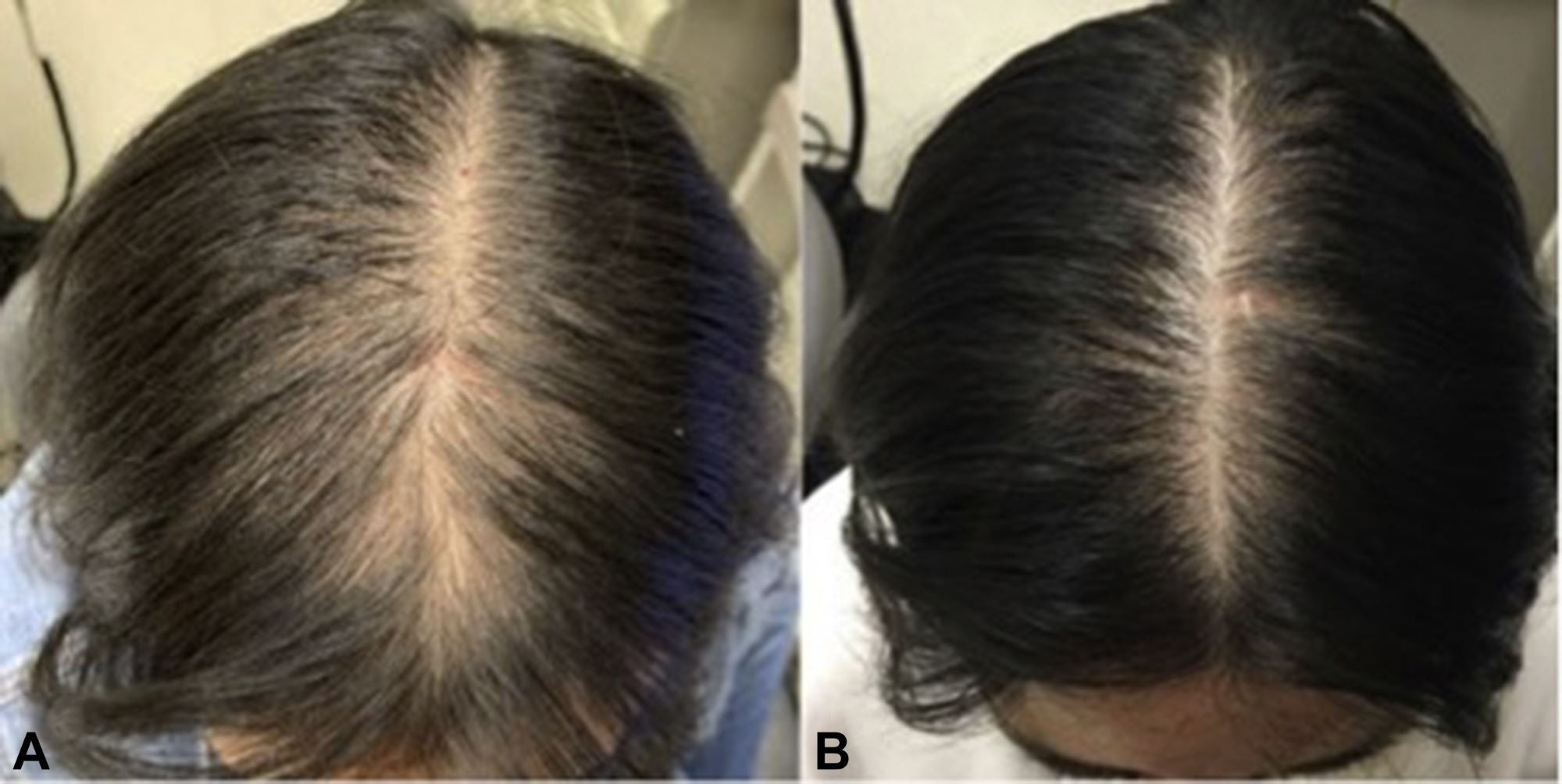 HAIR GROWTH TREATMENT OIL with Peppermint Oil, Tea Tree Oil, Argan oil, Jojoba seed, Avocado oil, Castor oil, Sweet Almond, Vitamin E Oil for Scalp and Hair