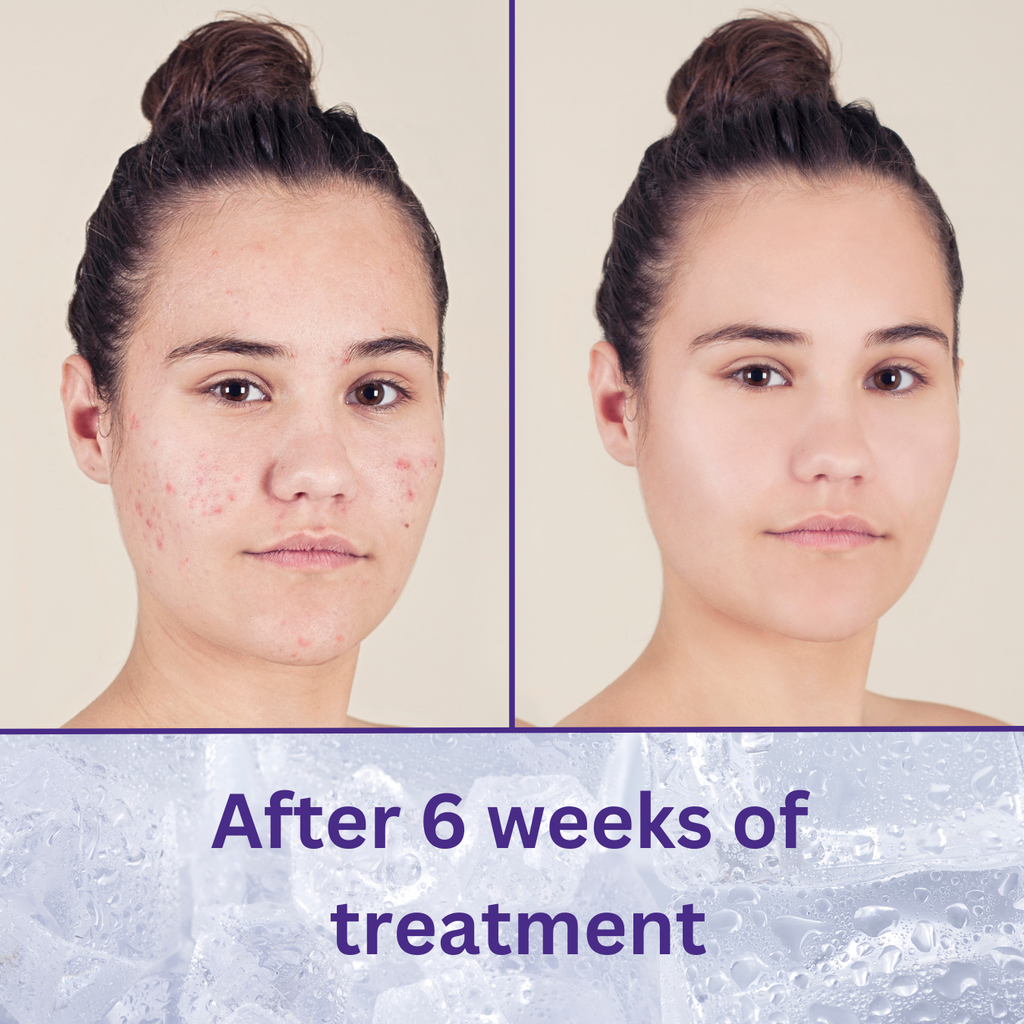 Clear Complexion Acne Kit