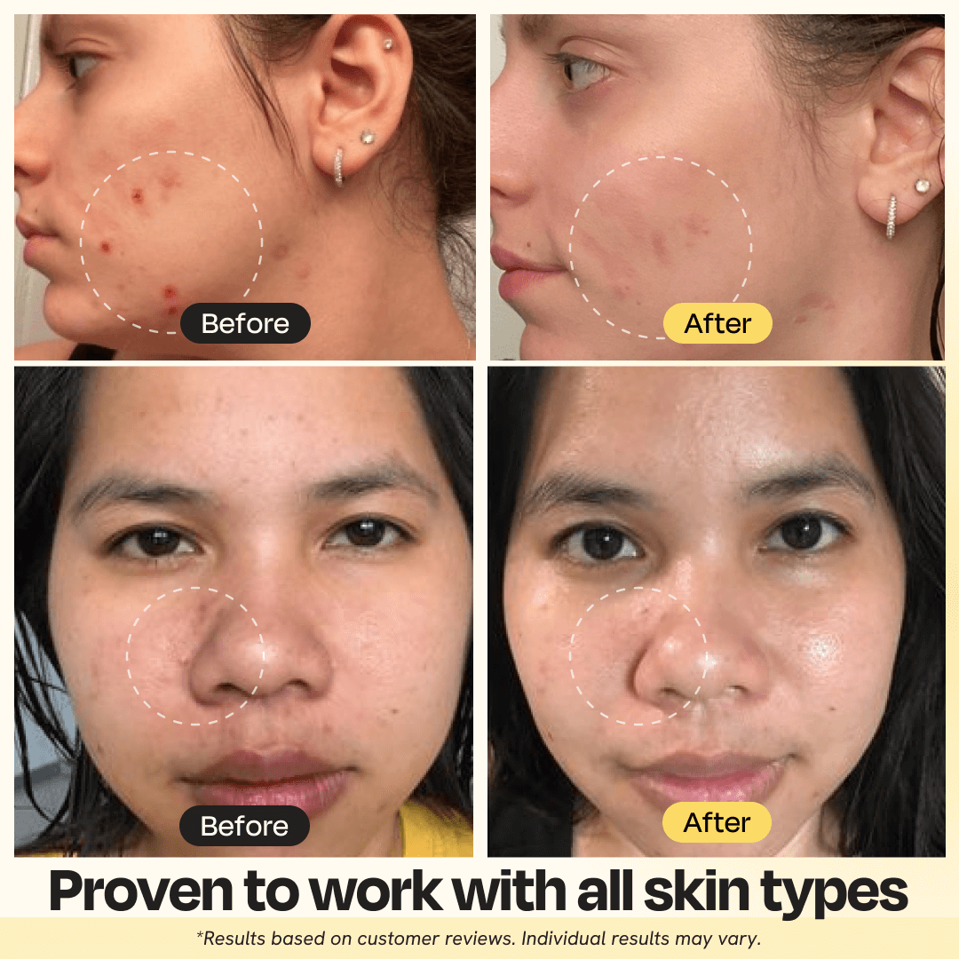 Before and after comparison of skin treatment on a person's face with text indicating proven effectiveness for all skin types.