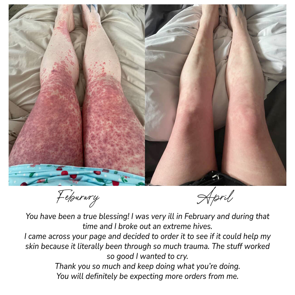 Comparison of legs with hives in February and April, with a testimonial below. Fragrance Free Tallow + Honey Cream for Sensitive Skin