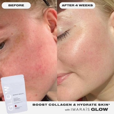 Before-and-after comparison showing visible improvement in facial skin after four weeks of using Imaraïs Glow vegan, sugar-free skincare gummies, with smoother, more radiant, hydrated-looking skin.