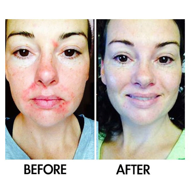 Before and after comparison of a woman with acne-prone skin, showing visible improvement in redness, blemishes, and overall skin clarity after using a skin-perfecting facial serum.