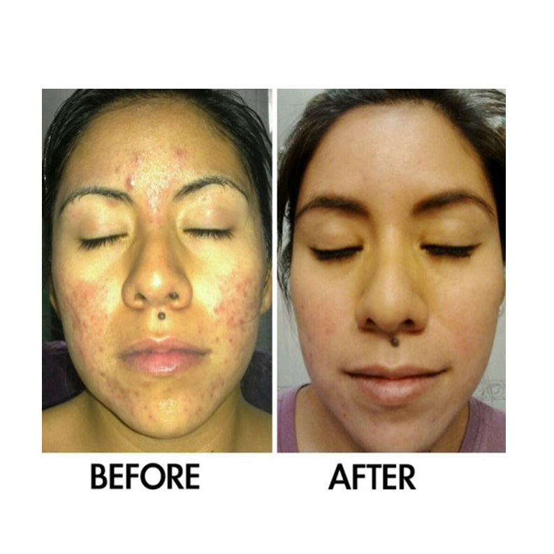 Before and after comparison showing improvement in facial acne, redness, and blemishes after using a skincare treatment, with visibly clearer, smoother, and more even-toned skin.