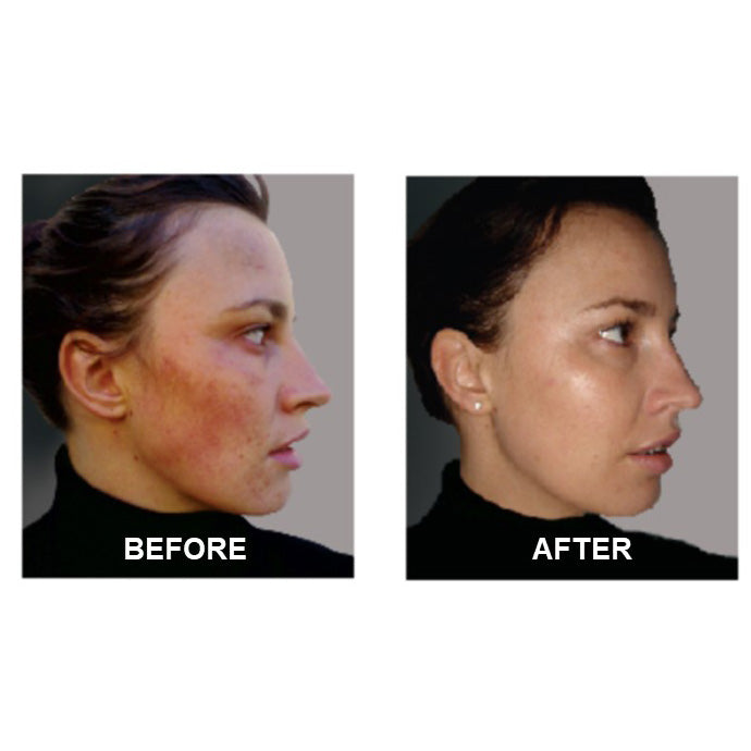Before and after comparison of adult acne treatment showing visible reduction in acne, redness, inflammation, and blemishes with smoother, clearer, more even-toned skin on a woman's face.