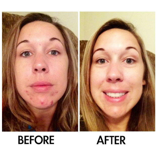 Before-and-after comparison showing a woman's facial skin with visible adult acne and blemishes before treatment and a clearer, smoother complexion after using a skin-perfecting acne and rosacea serum.