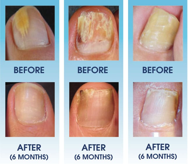 Organic Toenail Fungus Treatment Extra Strength - nail repair, toenail softener yellow toenail treatment, ingrown nail and foot fungus treatment extra strength